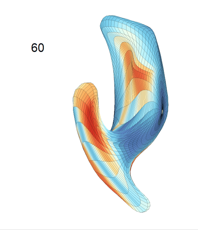 ventricle_AD_regression_surface