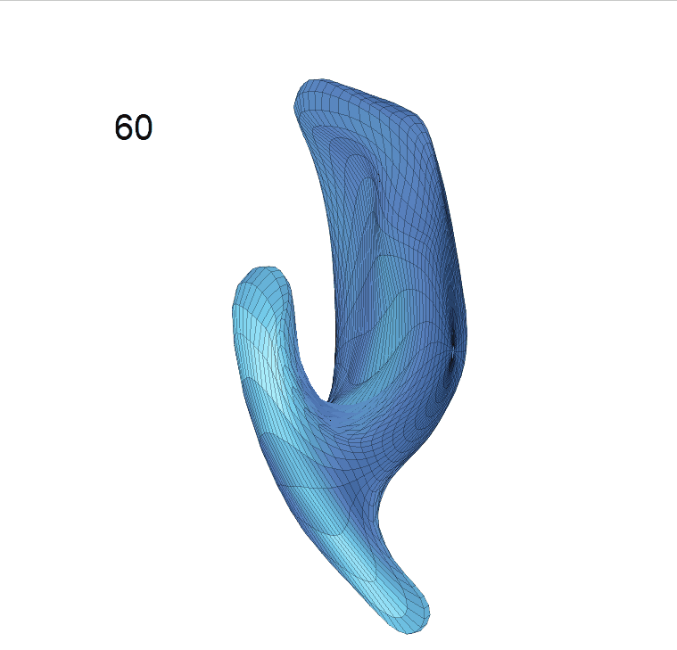 ventricle_MCI_shape