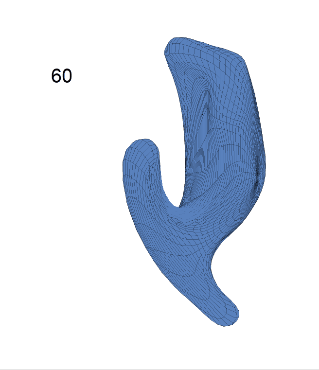 ventricle_AD_regression_surface